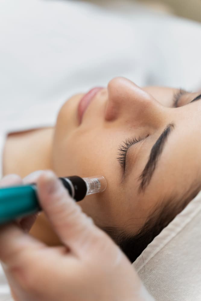 Dermapen microneedling